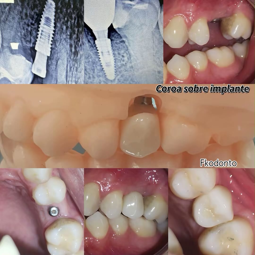 Casos de implante dentário: instalação, raio-X e coroa sobre implante finalizada
