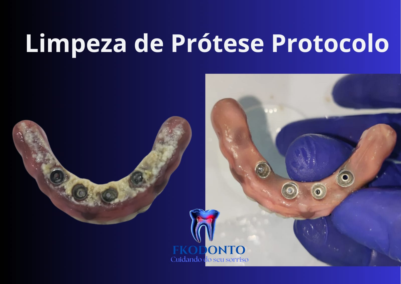 Protocolo de limpeza de prótese sobre implante antes e depois