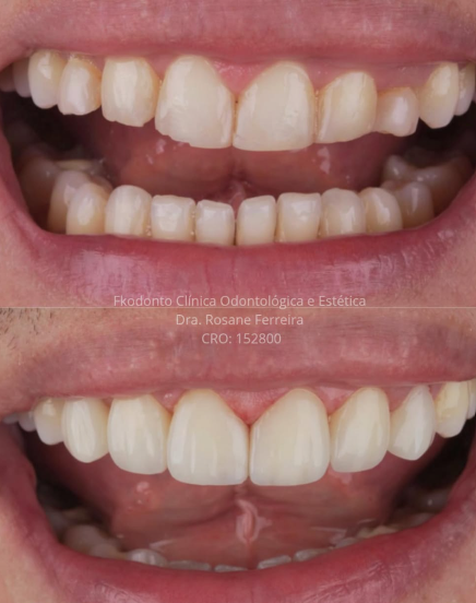 Registro clínico de reabilitação estética realizada na FKODONTO